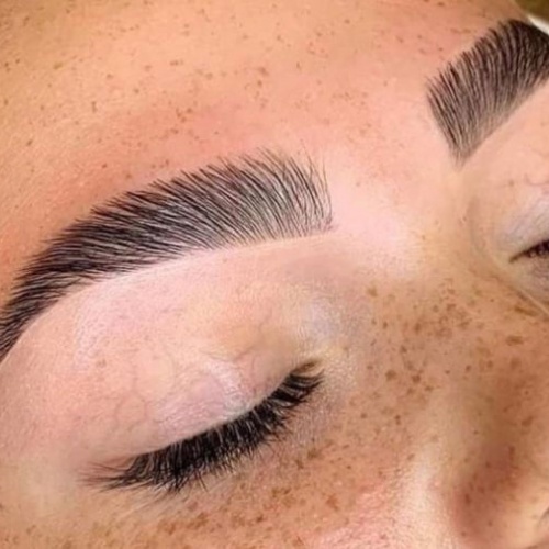 Brow lift